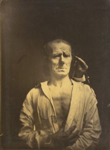 Spasme de m. corrugator supercilii sous une lumière très forte (à gauche) ; visage détendu (photographié en plein soleil) (à droite)
1854-1855, imprimé en 1862 (photo) - Guillaume-Benjamin-Armand Duchenne de Boulogne