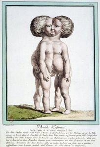 Enfants siamois - dans « Les déviations de la nature » par Régnault