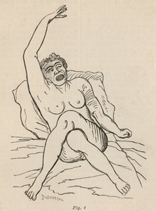 Épilepsie hystérique, attaque, contorsions, fig. 1 de 