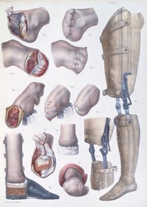 Amputations et Prothèses, planche de 
