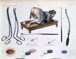 Opération sur une fistule vésico-vaginale, planche de 