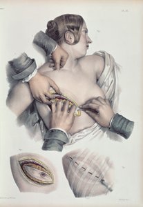 Opération sur une tumeur cancéreuse, tirée de 