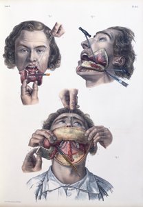 Opération sur la mâchoire inférieure, planche de 