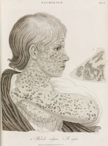 Maladies, rougeole Deux types de rougeole
