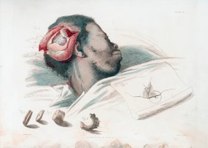 Vue de la blessure au crâne après trépanation et retrait du morceau d