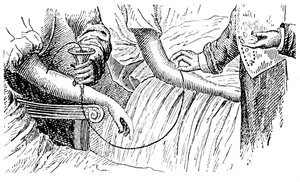 Transfusion sanguine, vers 1880 - Unbekannt