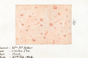 Maladies, varicelle Aquarelle de la maladie de la peau varicelle, 27 février 1902