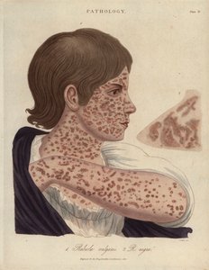 Rougeole et rubéole - Lithographie de John Pass, publiée dans «Encyclopedia Londinensis» par John Wilkes, édition J.Adlard, Londres