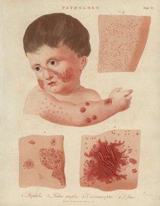 Maladies de la peau des nourrissons