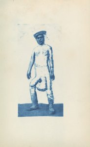 Éléphantiasis