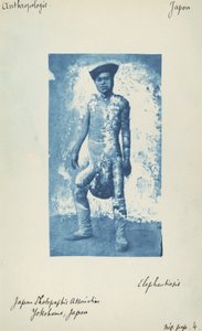 Éléphantiasis