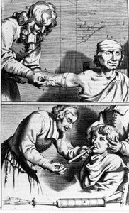 Saignée et douche nasale par Johannes Sculpteti Armamentarium Chirurgicum Amsterdam 1672