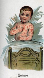Maladies infantiles : Urticaire. dans « La nouvelle médecine naturelle » par F.E. Bilz