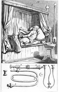 Clystère (pour lavements) par Johannes Sculptetus « Armamentarium Chirurgicum ». Venise 1665. - Unknown artist