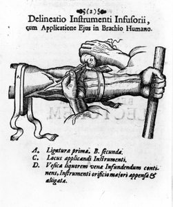 Injection intraveineuse utilisant une vessie de clystère. par J. D. Mayor, « Chirurgie Infusoria », Kilonii 1667.