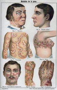 Maladies de la peau : Eczéma, herpès labial, psoriasis, zona, lupus (darter pourrissant), prurigo, érythème. Dans "La nouvelle médication naturelle" de F.E. Bilz