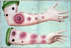 Symptômes de la variole causant une éruption de pustules sur la peau. Planche médicale du « Traité de la vaccination » par Luigi Sacco, Milan