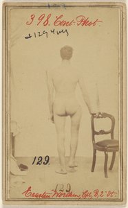 Fracture du tiers supérieur du fémur. Erastus Worthen, Corp Co. B. 2nd Vermont Vols. 25 ans - Domicile Stockbridge VT. - Unknown artist