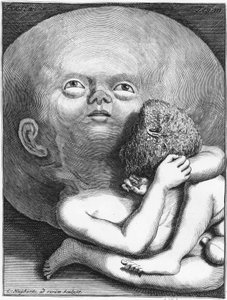 Monstre : Enfant hydrocéphale anthropologie - gravure, n.d., fin XVIIIe siècle