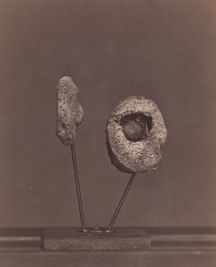 Articulation du genou excisée. Une balle de mousquet ronde dans le condyle interne du fémur droit