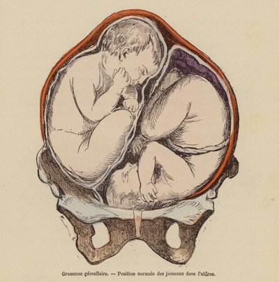 Position normale des jumeaux dans l