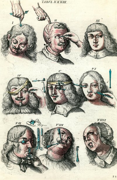 Chirurgie au XVIIIe siècle : trépanation et opération de l