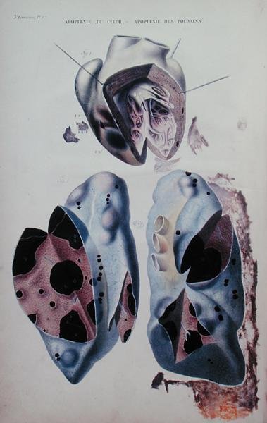 Apoplexie du cœur et des poumons, planche d