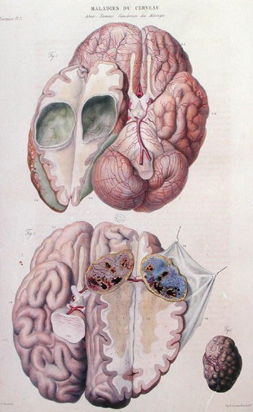 Tumeurs cancéreuses du cerveau, de 