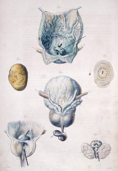 Maladies de la vessie et de la prostate, de 