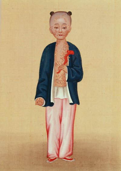 Enfant avec la variole - Chinese School