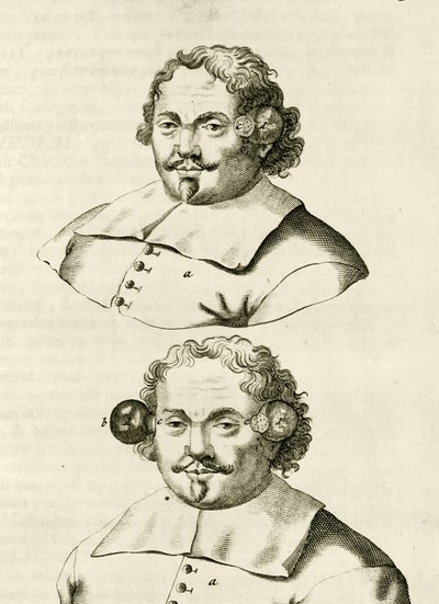 Un exemple de ventouses, de Exercitationes Practicae circa Medendi Methodum par Frederik Dekkers, 1694 - Dutch School