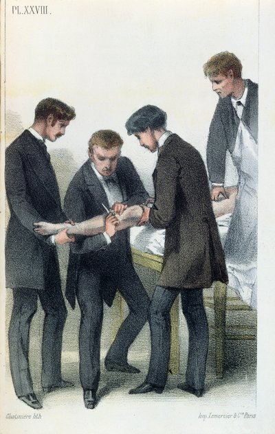 Amputation d