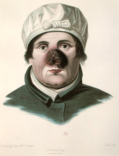 Avant une opération de greffe de peau, de 