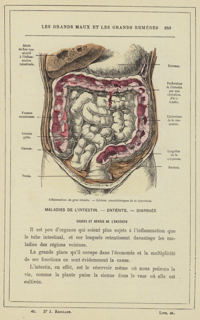 Inflammation du gros intestin, Lésions caractéristiques de la dysenterie - French School