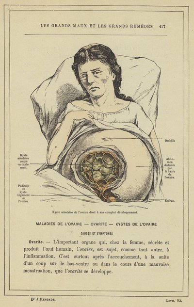 Kyste aréolaire de l