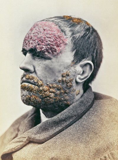 Homme souffrant de syphilis, d