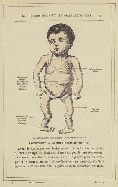 Principales déformations osseuses chez un enfant rachitique - French School