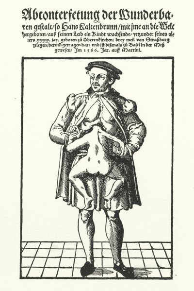 Hans Kaltenbrunn et son jumeau conjoint non développé - German School