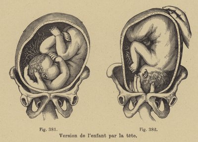 Tourner un bébé dans le ventre de sa mère pour que la tête soit orientée vers le bas avant la naissance - German School