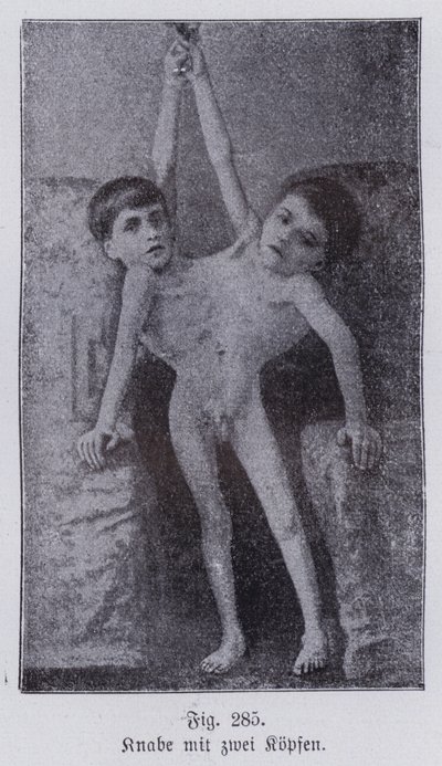 Giacomo et Giovanni Battista Tocci, jumeaux siamois italiens - Italian Photographer