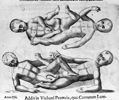 Différents types de monstres humains : enfants siamois reliés par le bassin. Gravure de « De monstrorum natura, causis et differentiis » de Fortunio Liceti (1577-1656), scientifique italien. 1646 - Italian School