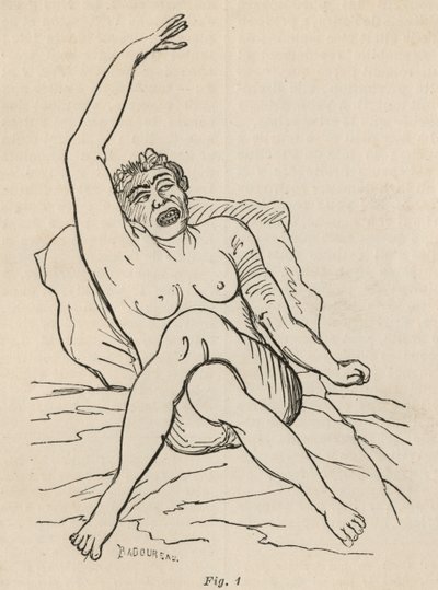 Épilepsie hystérique, attaque, contorsions, fig. 1 de 