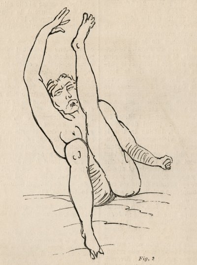Épilepsie hystérique, attaque, contorsions, fig. 2 de 
