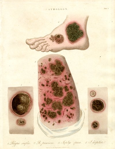 Pathologies cutanées - Pityria, impétigo et syphilis - John Pass