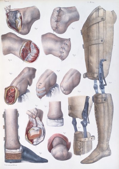Amputations et Prothèses, planche de 