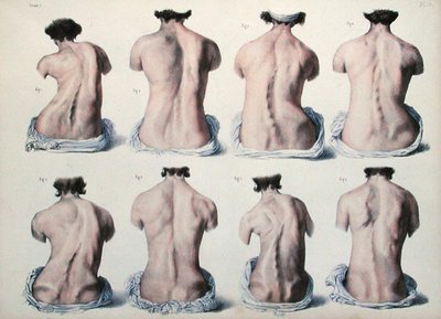 Déformations de la colonne vertébrale, planche de 