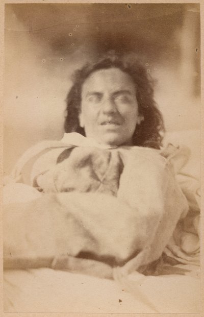 Épilepsie hystérique, hallucinations, ironie, planche XXXII de 