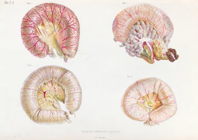 Surface externe des intestins infectés par le choléra, de Anatomie Pathologique du Cholera Morbus, par Nikolai Ivanovich Pirogov, publié à Saint-Pétersbourg, 1849 - Russian School