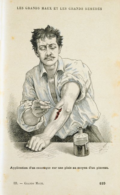Peindre une plaie avec une solution antiseptique, vers 1890 - Unbekannt