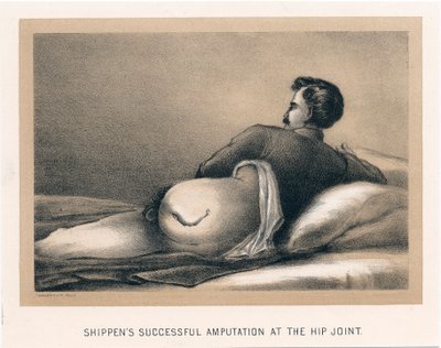 Amputation réussie de Shippen à l